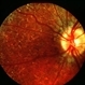Widespread pigment changes